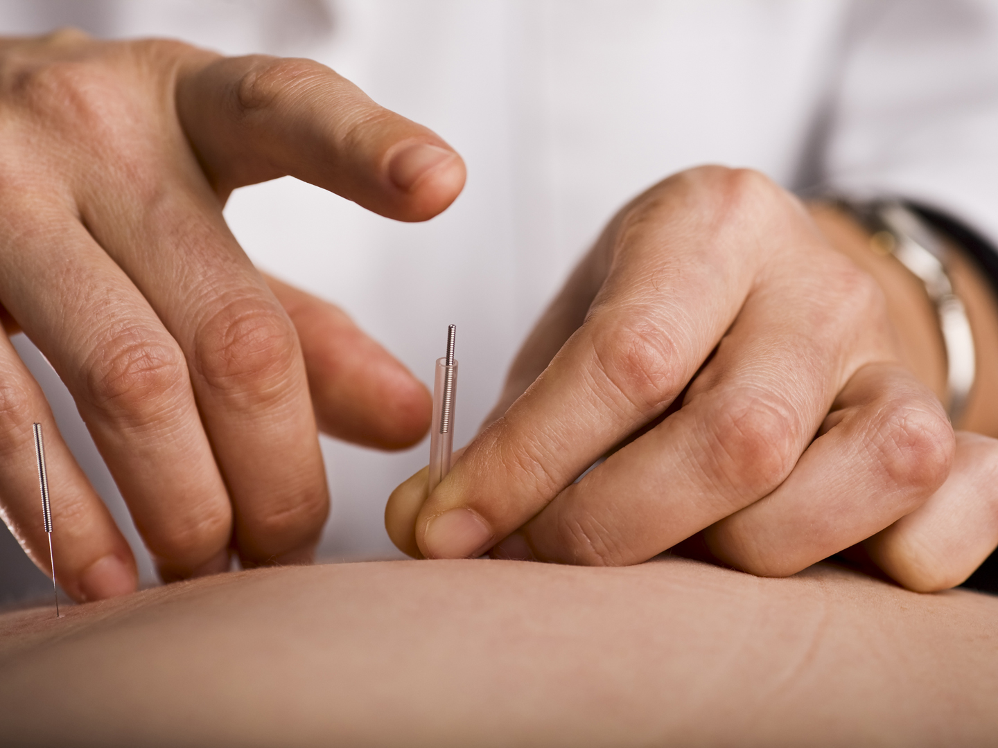 Acupuncturist准备用针插进病人手